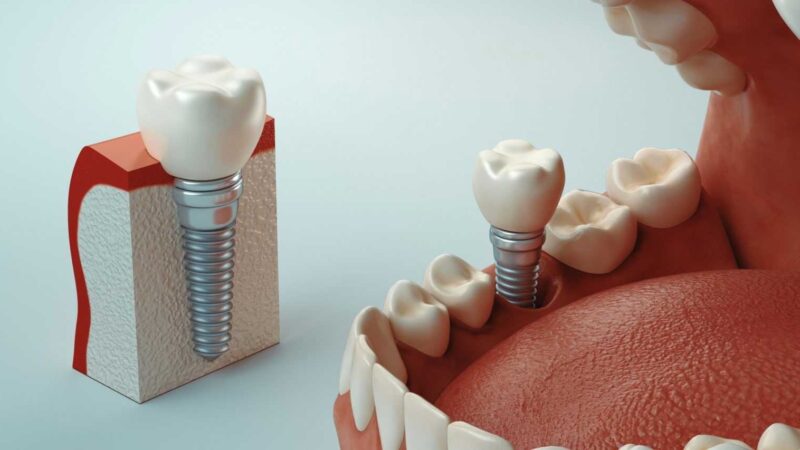 Имплантация зубов: современные подходы